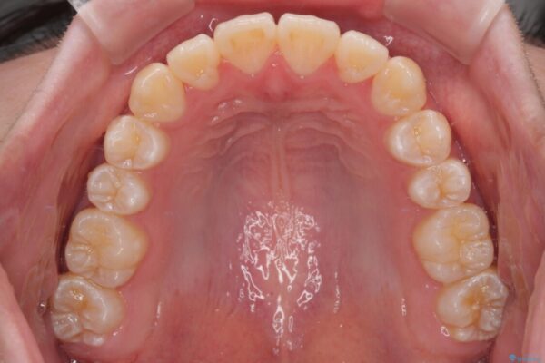 【モニター】前歯のデコボコをスッキリ解消!目立ちにくいワイヤー矯正でスピーディに治療完了 治療後画像