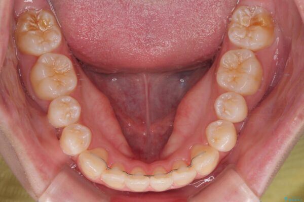 【モニター】前歯のデコボコをスッキリ解消!目立ちにくいワイヤー矯正でスピーディに治療完了 治療後画像