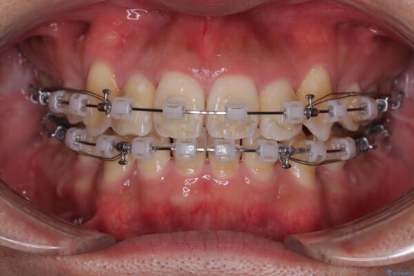 八重歯と前歯のガタガタを抜歯矯正で治療|クリアブラケット使用例 治療途中画像