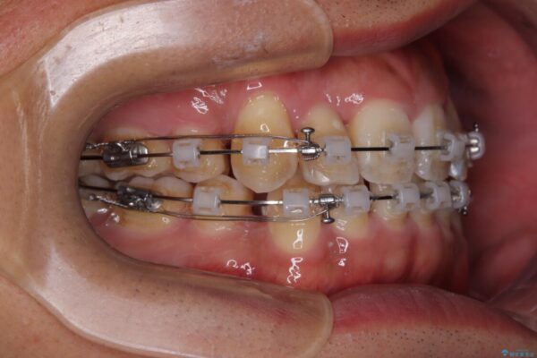 八重歯と前歯のガタガタを抜歯矯正で治療|クリアブラケット使用例 治療途中画像