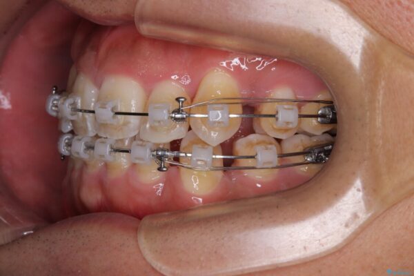 八重歯と前歯のガタガタを抜歯矯正で治療|クリアブラケット使用例 治療途中画像
