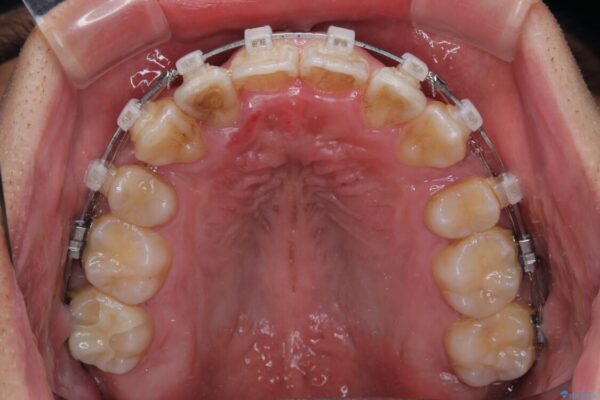 八重歯と前歯のガタガタを抜歯矯正で治療|クリアブラケット使用例 治療途中画像