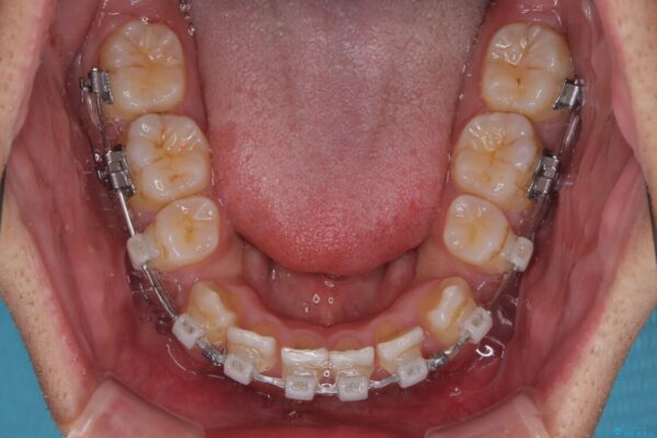 八重歯と前歯のガタガタを抜歯矯正で治療|クリアブラケット使用例 治療途中画像