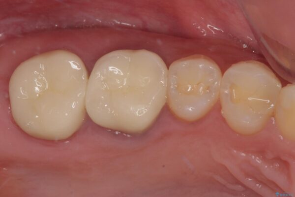 挺出歯を圧下してスペースを確保!目立たない部分矯正で下顎大臼歯にインプラント治療を実現 治療後画像