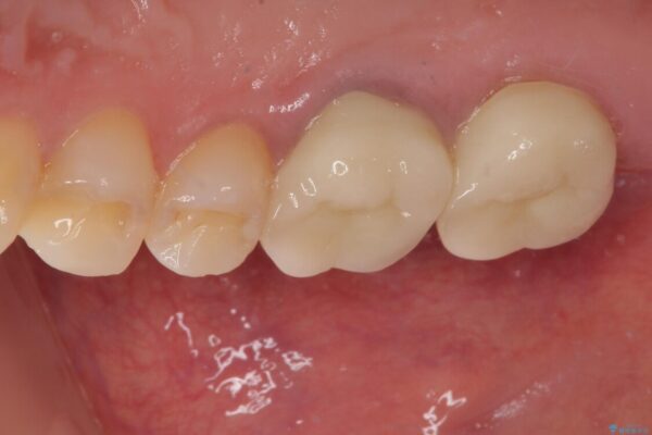 挺出歯を圧下してスペースを確保!目立たない部分矯正で下顎大臼歯にインプラント治療を実現 治療後画像