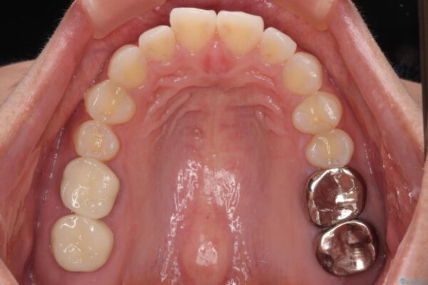 挺出歯を圧下してスペースを確保!目立たない部分矯正で下顎大臼歯にインプラント治療を実現 治療後画像