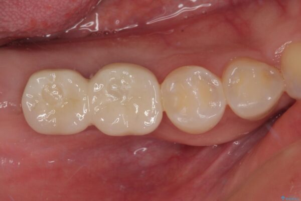 挺出歯を圧下してスペースを確保!目立たない部分矯正で下顎大臼歯にインプラント治療を実現 治療後画像
