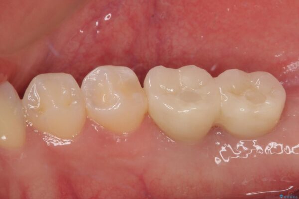 挺出歯を圧下してスペースを確保!目立たない部分矯正で下顎大臼歯にインプラント治療を実現 治療後画像