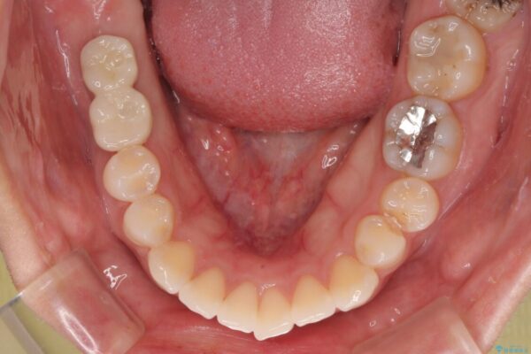 挺出歯を圧下してスペースを確保!目立たない部分矯正で下顎大臼歯にインプラント治療を実現 治療後画像