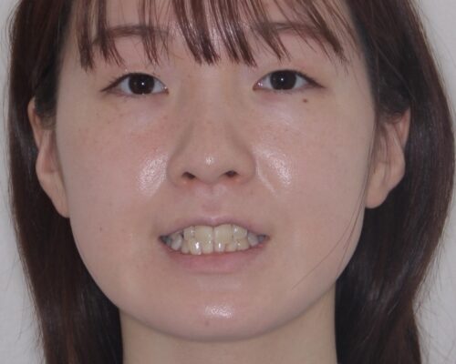 【モニター】前歯のデコボコをスッキリ解消!目立ちにくいワイヤー矯正でスピーディに治療完了 治療前画像