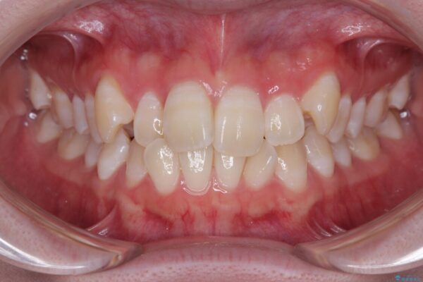 【モニター】前歯のデコボコをスッキリ解消!目立ちにくいワイヤー矯正でスピーディに治療完了 ビフォー