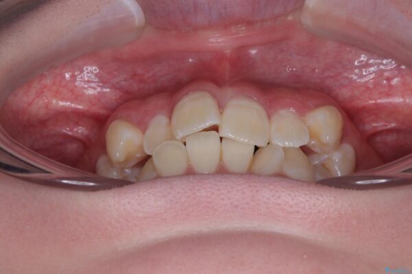 【モニター】前歯のデコボコをスッキリ解消!目立ちにくいワイヤー矯正でスピーディに治療完了 治療前画像