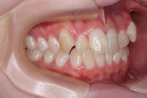 【モニター】前歯のデコボコをスッキリ解消!目立ちにくいワイヤー矯正でスピーディに治療完了 治療前画像