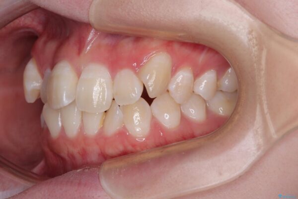 【モニター】前歯のデコボコをスッキリ解消!目立ちにくいワイヤー矯正でスピーディに治療完了 治療前画像