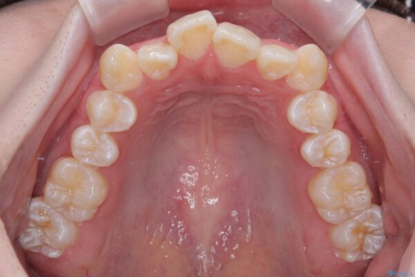 【モニター】前歯のデコボコをスッキリ解消!目立ちにくいワイヤー矯正でスピーディに治療完了 治療前画像