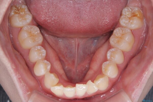 【モニター】前歯のデコボコをスッキリ解消!目立ちにくいワイヤー矯正でスピーディに治療完了 治療前画像