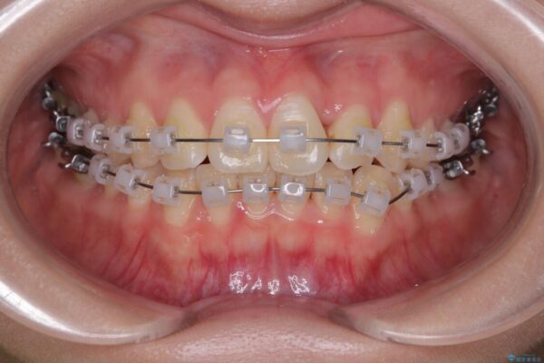 前歯のねじれ・ガタガタを10か月で改善!20代女性の矯正治療|クリアブラケットでむし歯になりにくい歯並びへ改善 治療途中画像