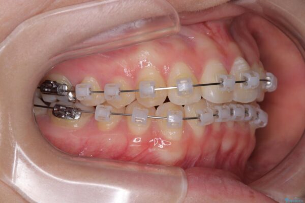 前歯のねじれ・ガタガタを10か月で改善!20代女性の矯正治療|クリアブラケットでむし歯になりにくい歯並びへ改善 治療途中画像