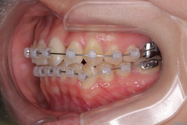 前歯のねじれ・ガタガタを10か月で改善!20代女性の矯正治療|クリアブラケットでむし歯になりにくい歯並びへ改善 治療途中画像