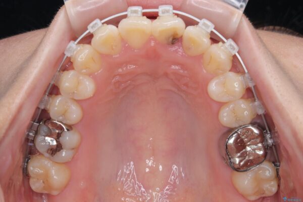 前歯のねじれ・ガタガタを10か月で改善!20代女性の矯正治療|クリアブラケットでむし歯になりにくい歯並びへ改善 治療途中画像