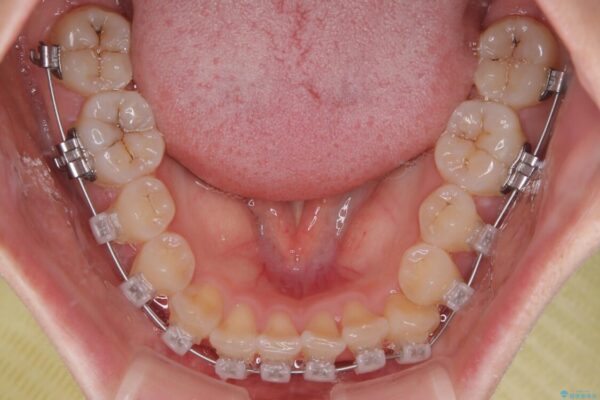前歯のねじれ・ガタガタを10か月で改善!20代女性の矯正治療|クリアブラケットでむし歯になりにくい歯並びへ改善 治療途中画像