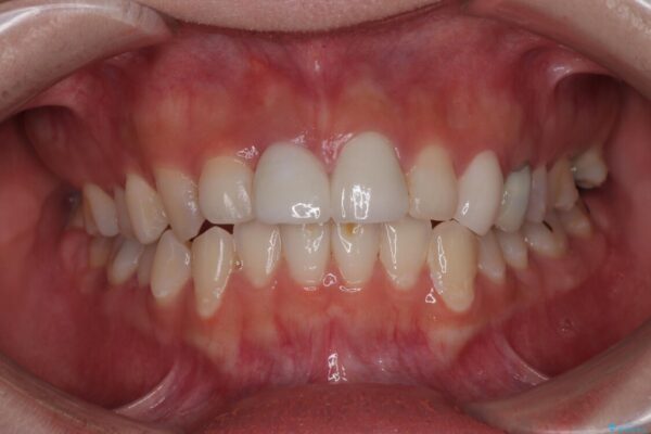 「抜歯してブリッジ」と言われた20代女性が選んだ治療とは|たった4か月で自然な笑顔に抜歯即時インプラント+審美補綴の症例 アフター