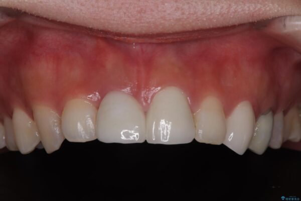 「抜歯してブリッジ」と言われた20代女性が選んだ治療とは|たった4か月で自然な笑顔に抜歯即時インプラント+審美補綴の症例 治療後画像