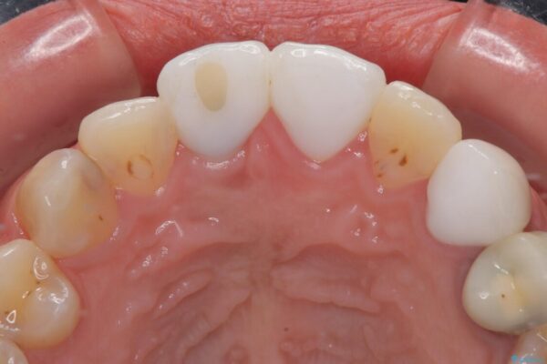 「抜歯してブリッジ」と言われた20代女性が選んだ治療とは|たった4か月で自然な笑顔に抜歯即時インプラント+審美補綴の症例 治療後画像