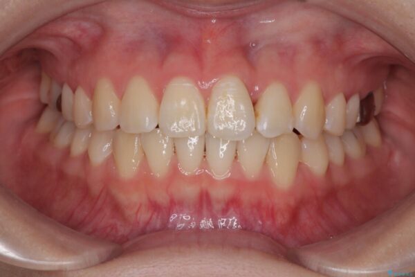 前歯のねじれ・ガタガタを10か月で改善!20代女性の矯正治療|クリアブラケットでむし歯になりにくい歯並びへ改善 アフター