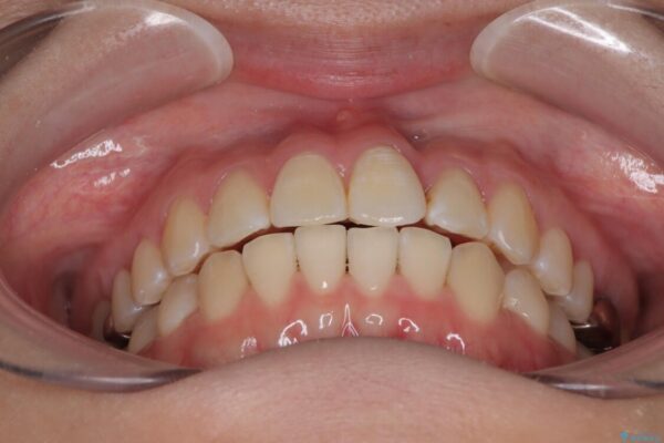 前歯のねじれ・ガタガタを10か月で改善!20代女性の矯正治療|クリアブラケットでむし歯になりにくい歯並びへ改善 治療後画像