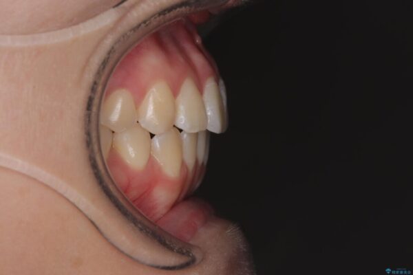 前歯のねじれ・ガタガタを10か月で改善!20代女性の矯正治療|クリアブラケットでむし歯になりにくい歯並びへ改善 治療後画像