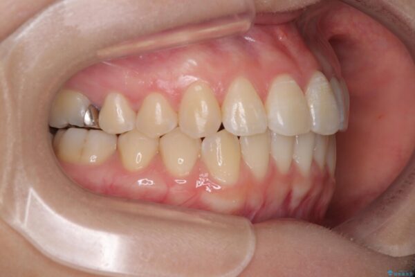 前歯のねじれ・ガタガタを10か月で改善!20代女性の矯正治療|クリアブラケットでむし歯になりにくい歯並びへ改善 治療後画像