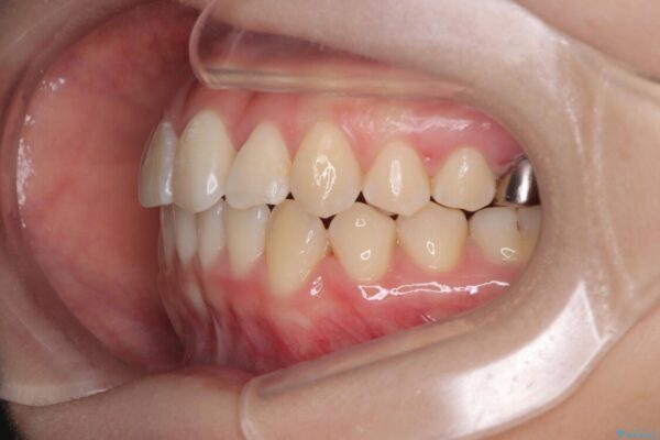 前歯のねじれ・ガタガタを10か月で改善!20代女性の矯正治療|クリアブラケットでむし歯になりにくい歯並びへ改善 治療後画像