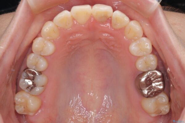 前歯のねじれ・ガタガタを10か月で改善!20代女性の矯正治療|クリアブラケットでむし歯になりにくい歯並びへ改善 治療後画像