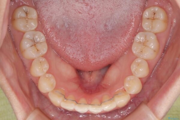 前歯のねじれ・ガタガタを10か月で改善!20代女性の矯正治療|クリアブラケットでむし歯になりにくい歯並びへ改善 治療後画像