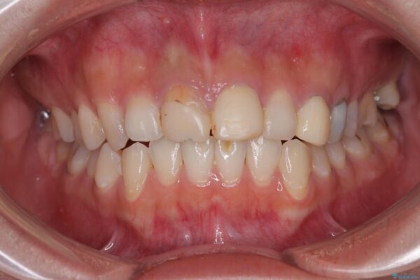 「抜歯してブリッジ」と言われた20代女性が選んだ治療とは|たった4か月で自然な笑顔に抜歯即時インプラント+審美補綴の症例 ビフォー