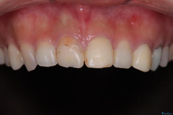 「抜歯してブリッジ」と言われた20代女性が選んだ治療とは|たった4か月で自然な笑顔に抜歯即時インプラント+審美補綴の症例 治療前画像