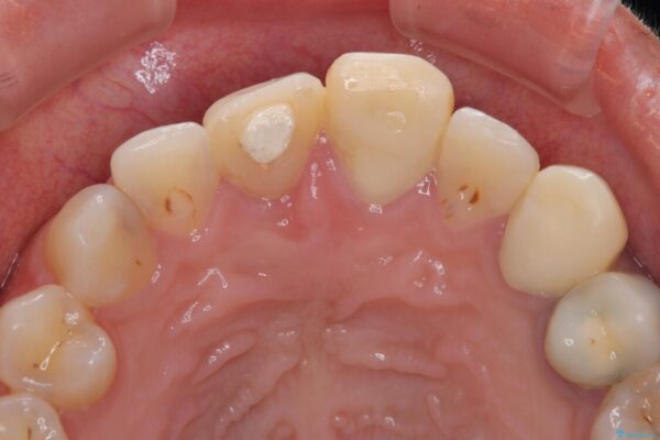 「抜歯してブリッジ」と言われた20代女性が選んだ治療とは|たった4か月で自然な笑顔に抜歯即時インプラント+審美補綴の症例 治療前画像