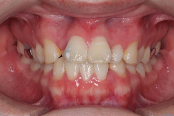 1年でここまで変わる!歯列のがたつきと正中のズレを改善した矯正治療(メタルブラケット×MARPE) 治療前画像