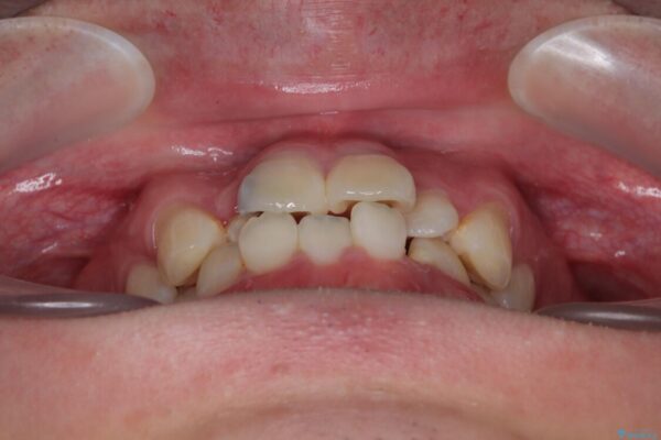 1年でここまで変わる!歯列のがたつきと正中のズレを改善した矯正治療(メタルブラケット×MARPE) 治療前画像