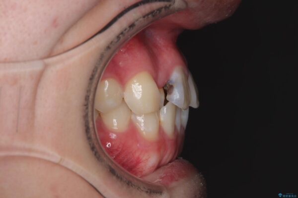 1年でここまで変わる!歯列のがたつきと正中のズレを改善した矯正治療(メタルブラケット×MARPE) 治療前画像