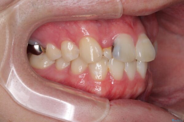 1年でここまで変わる!歯列のがたつきと正中のズレを改善した矯正治療(メタルブラケット×MARPE) 治療前画像
