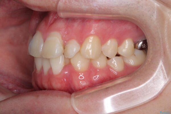 1年でここまで変わる!歯列のがたつきと正中のズレを改善した矯正治療(メタルブラケット×MARPE) 治療前画像