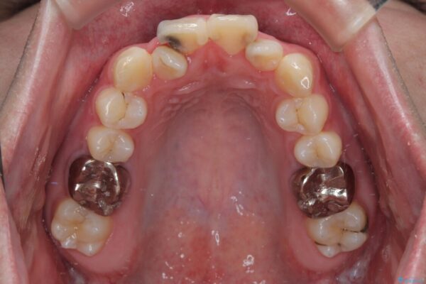 1年でここまで変わる!歯列のがたつきと正中のズレを改善した矯正治療(メタルブラケット×MARPE) 治療前画像