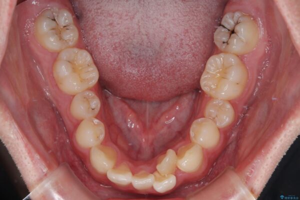 1年でここまで変わる!歯列のがたつきと正中のズレを改善した矯正治療(メタルブラケット×MARPE) 治療前画像