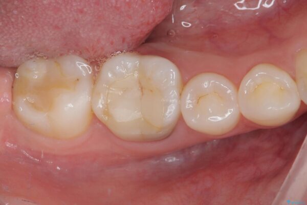 ラバーダム使用で再感染リスクを抑えた再根管治療+精密な補綴による長期安定を実現 ビフォー
