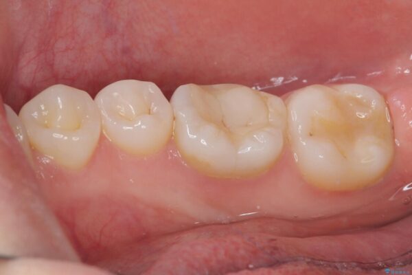 ラバーダム使用で再感染リスクを抑えた再根管治療+精密な補綴による長期安定を実現 治療前画像