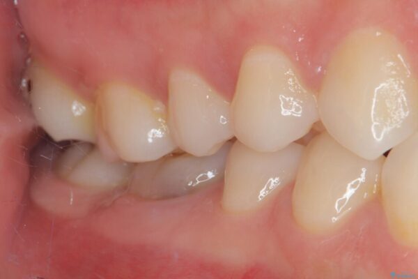 ラバーダム使用で再感染リスクを抑えた再根管治療+精密な補綴による長期安定を実現 治療前画像