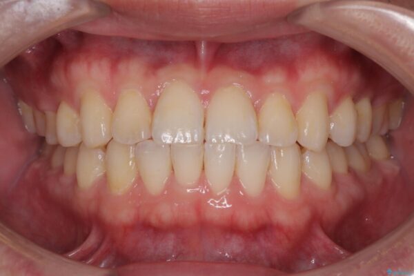 前歯のガタガタ・奥歯のかみ合わせ(シザーズバイト)を改善|1年半で完了したメタルブラケット矯正 アフター