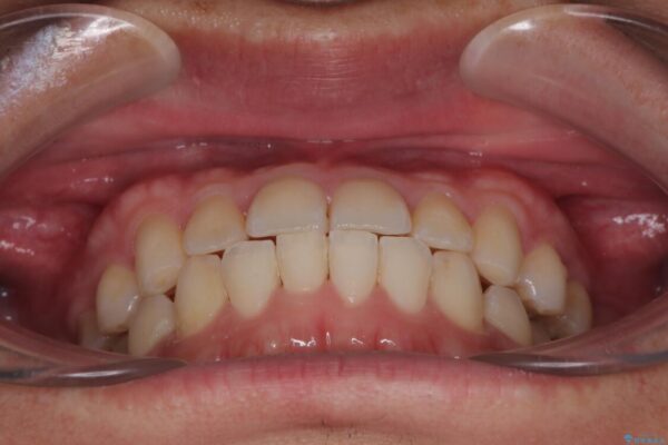 前歯のガタガタ・奥歯のかみ合わせ(シザーズバイト)を改善|1年半で完了したメタルブラケット矯正 治療後画像